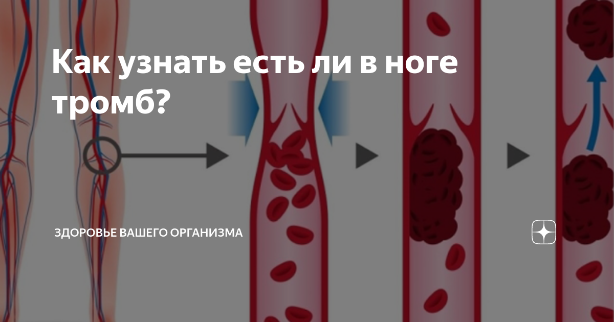 8 признаков тромбоза, которые опасно игнорировать ВАРИКОЗ Постила