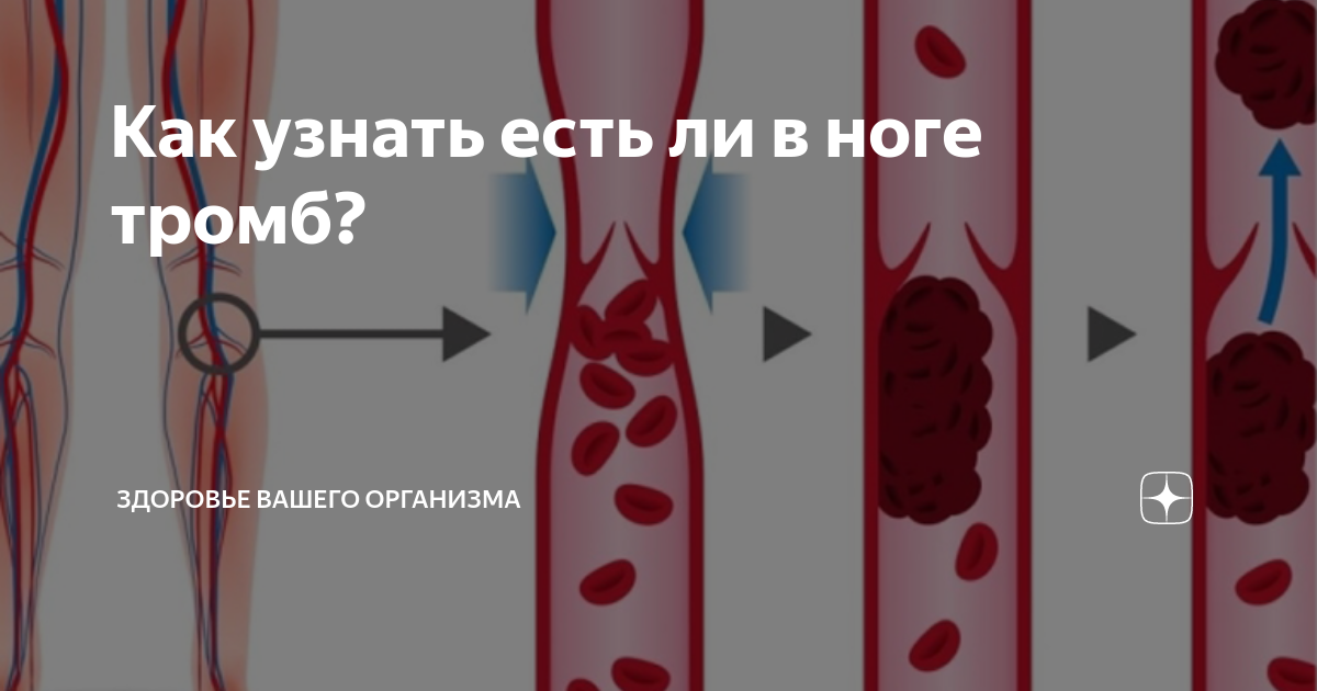 Можно ли проверить сосуды. Образование тромба на ноге. Как выглядит тромб в крови.