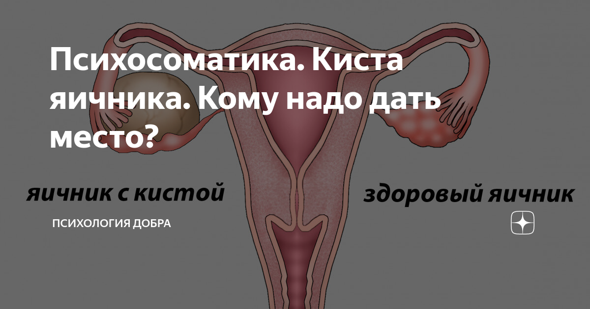 Психосоматика. Киста яичника. Кому надо дать место? | ПСИХОЛОГИЯ ДОБРА ...