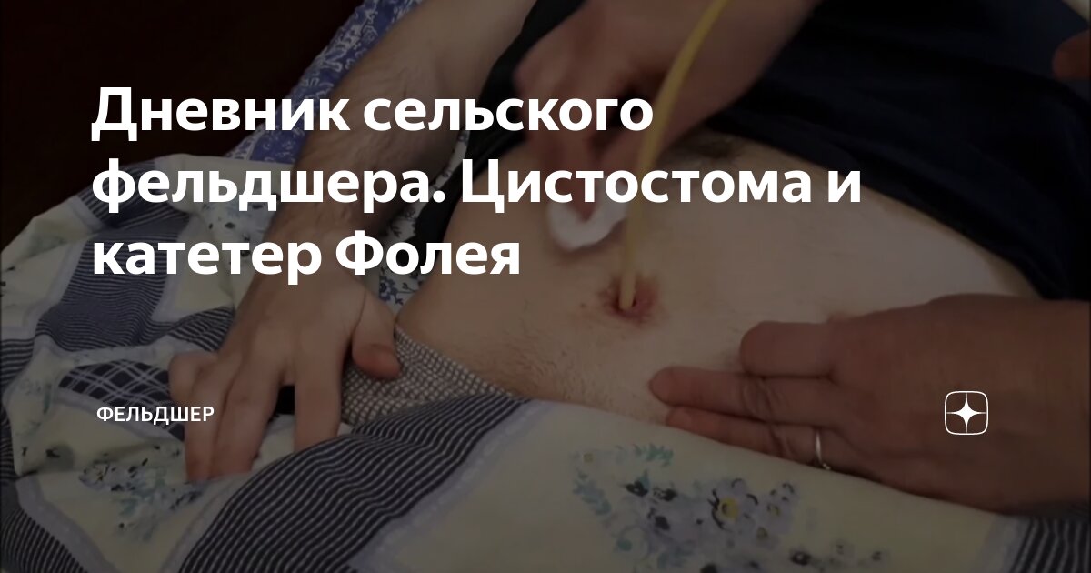 Катетер урологический Фолея универсальный, мужской двухходовой, Ch/Fr 16, 5 штук