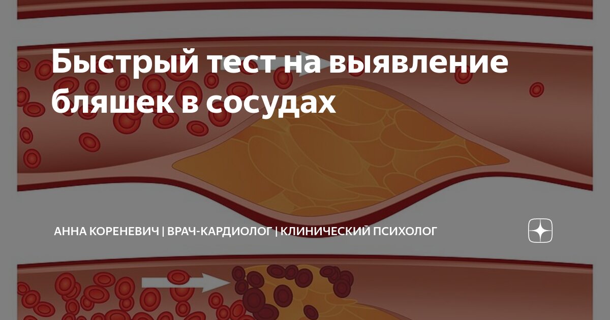 Нарушение жирового обмена ведущее к образованию бляшек на сосудистых стенках