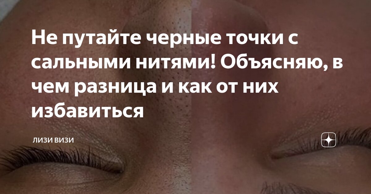 Не путайте черные точки с сальными нитями! Объясняю, в чем разница и ...