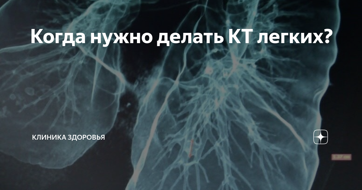 Когда нужно делать КТ легких? | Клиника Здоровья | Дзен