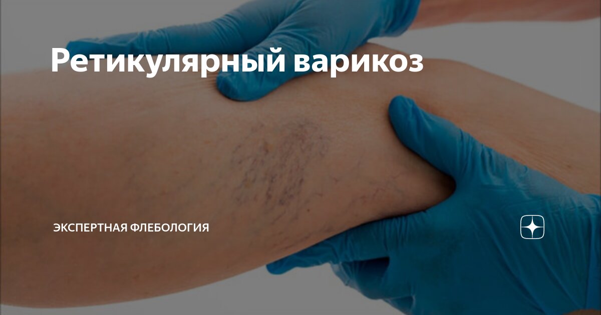 Ретикулярный варикоз | Экспертная флебология | Дзен