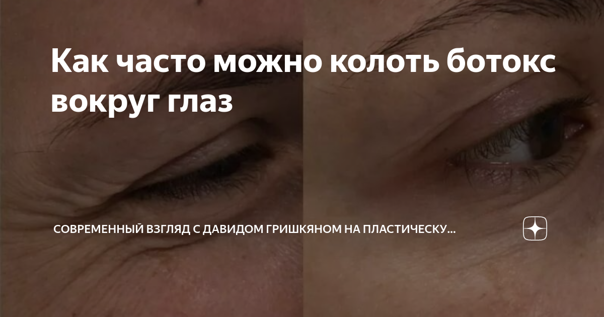 сколько ботокса нужно на глаза