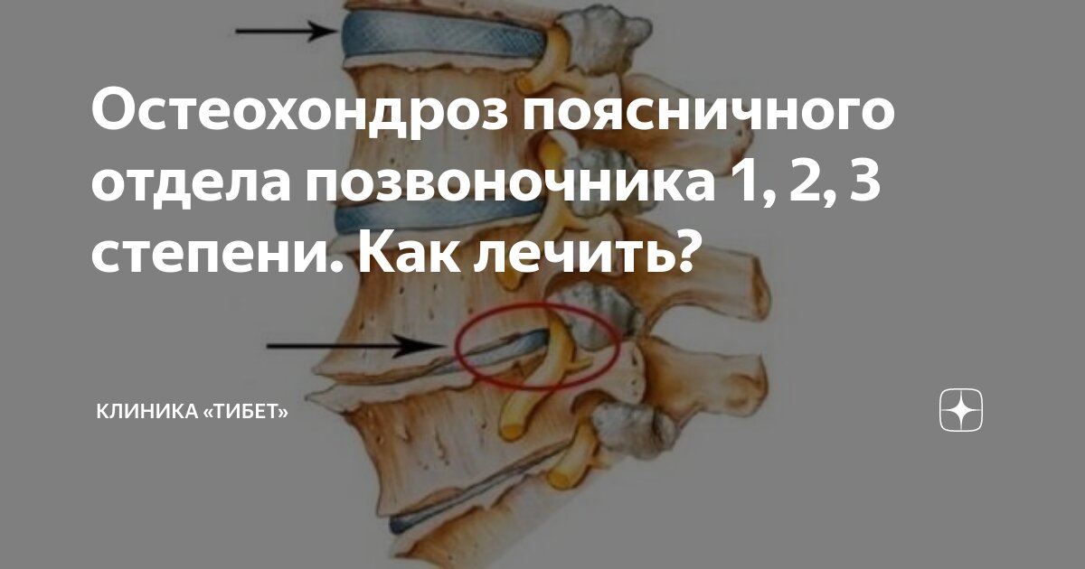 Как лечить остеохондроз пояснично-крестцового отдела позвоночника