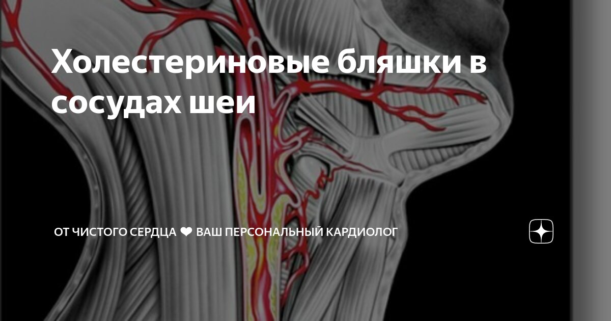 Холестериновые бляшки в сосудах шеи | От чистого сердца ️ Ваш ...