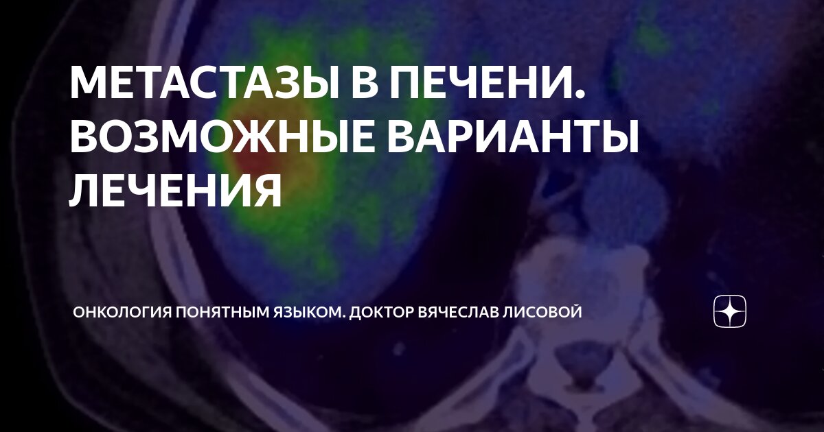 МЕТАСТАЗЫ В ПЕЧЕНИ. ВОЗМОЖНЫЕ ВАРИАНТЫ ЛЕЧЕНИЯ⁠⁠ | Онкология понятным ...