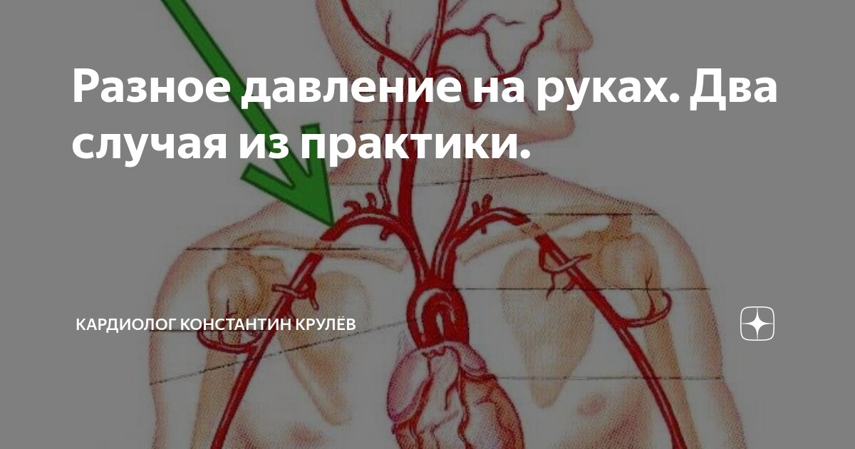 На разных руках разное давление. Почему на руках разное давление и большая. Разное давление на руках. На разных руках разное давление. Почему на руках разное давление и большая.