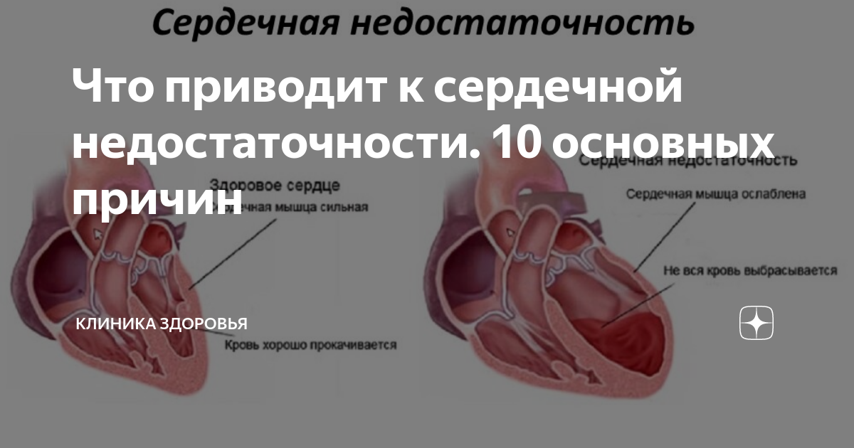 Что приводит к сердечной недостаточности. 10 основных причин | Клиника ...