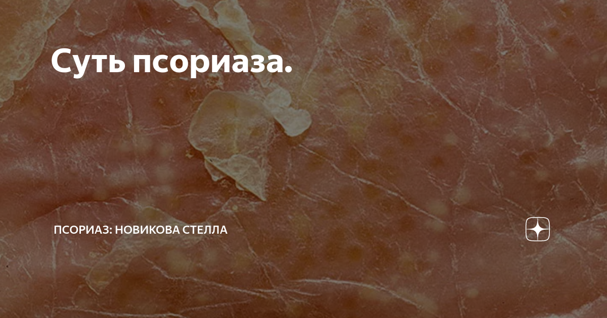 Суть псориаза. | ПСОРИАЗ: Новикова Стелла | Дзен