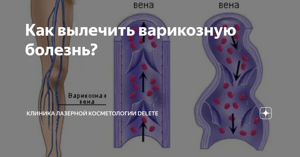 лечение варикоза вен в иркутске