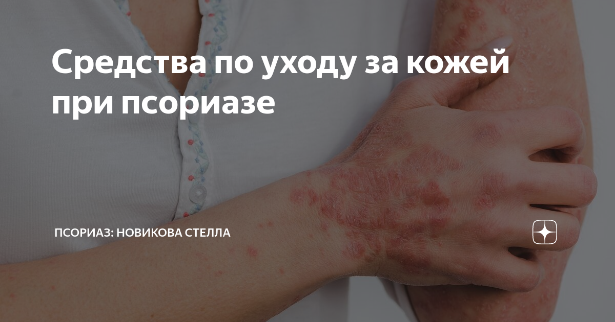 Средства по уходу за кожей при псориазе | ПСОРИАЗ: Новикова Стелла | Дзен