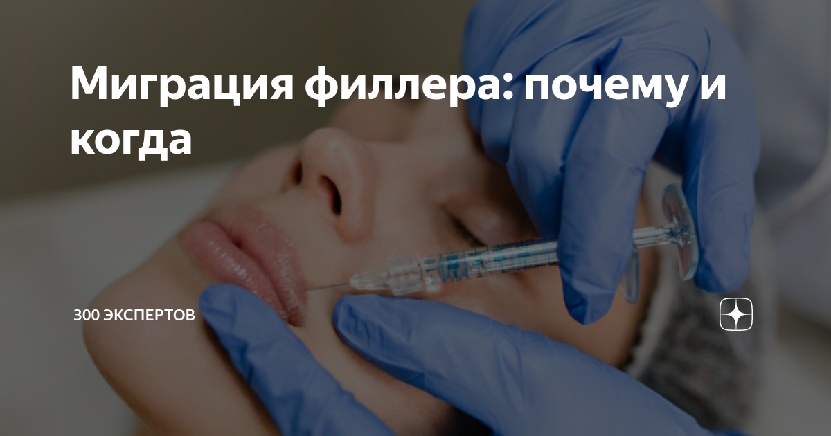 Миграция филлера: почему и когда | 300 ЭКСПЕРТОВ | Дзен