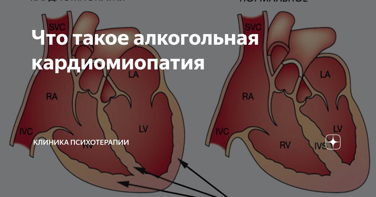 Что такое алкогольная кардиомиопатия | Клиника психотерапии | Дзен
