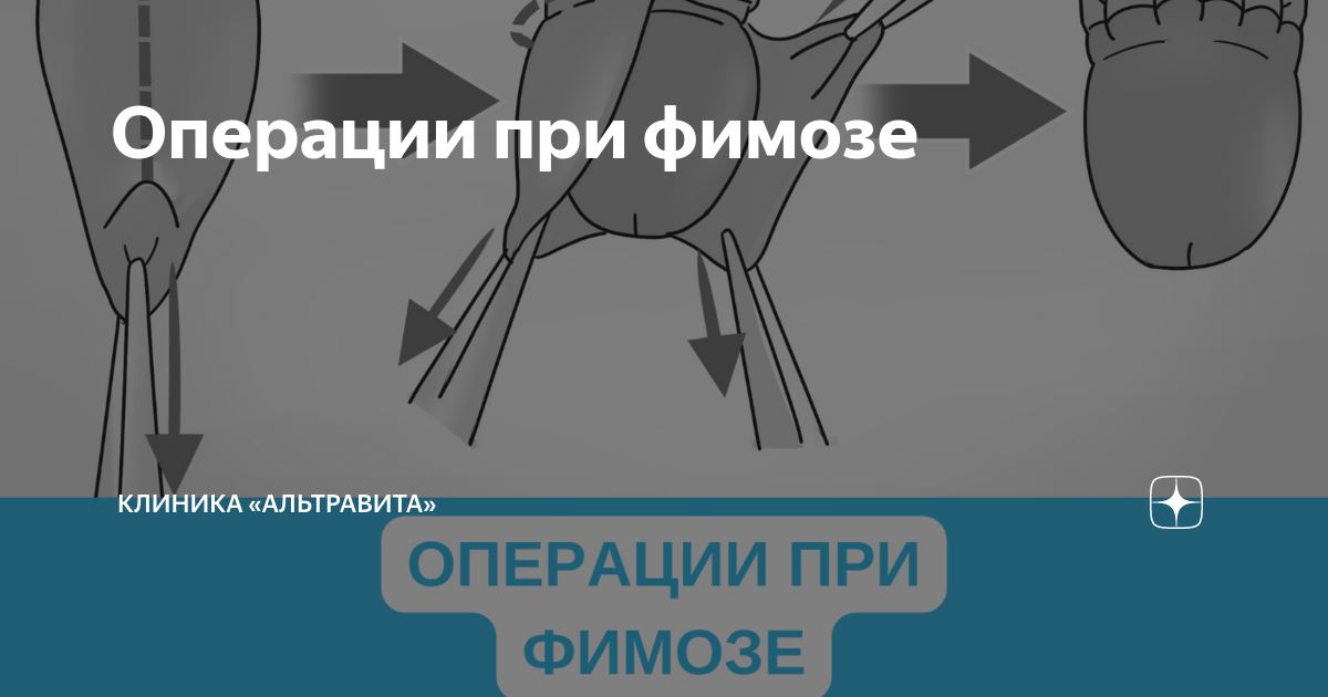Обрезание у мужчин схема зачем это