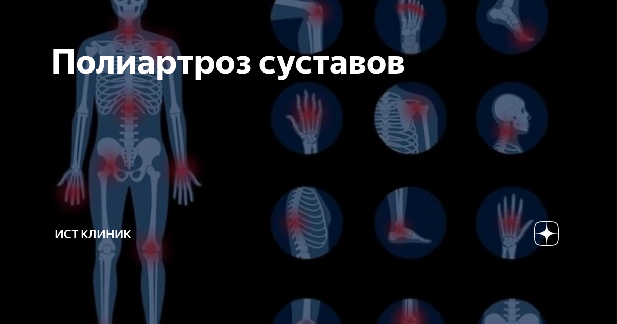 Полиартроз суставов | Ист Клиника - неврология, ортопедия, остеопатия ...