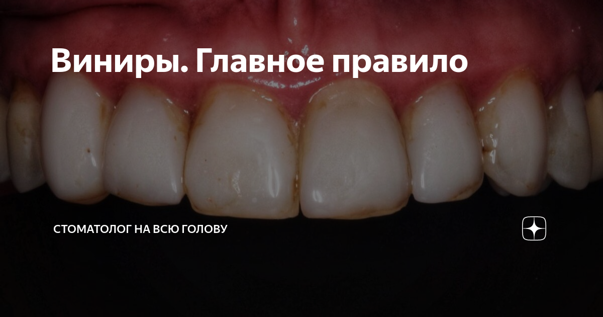 Виниры. Главное правило | Стоматолог на всю голову | Дзен