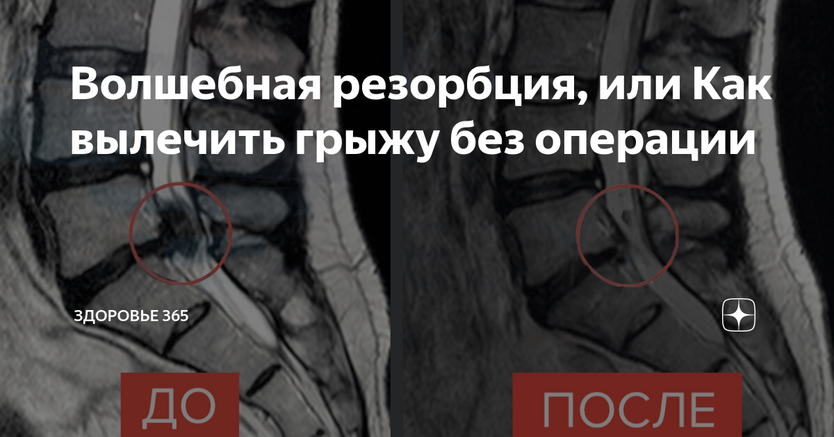 Волшебная резорбция, или Как вылечить грыжу без операции | ЗДОРОВЬЕ 365 ...
