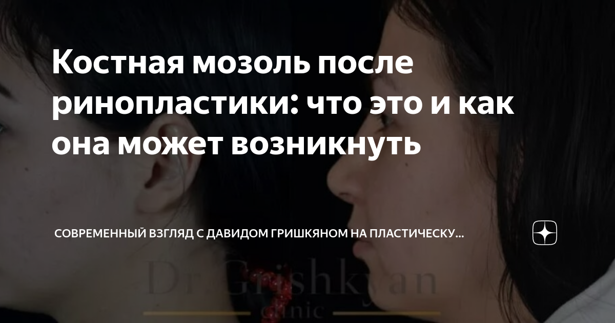 Как выглядит костная мозоль после ринопластики Фото до и после пластических операций. Ринопластика. Жолтиков В.В. от 03 Сентябр