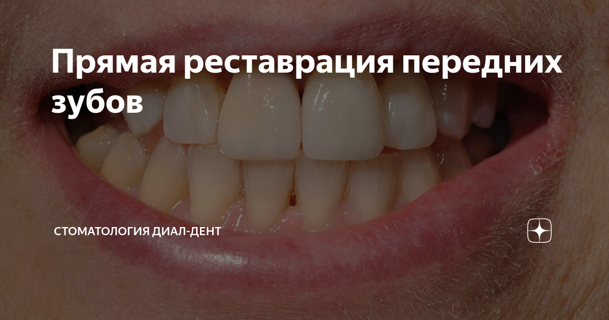 Прямая реставрация передних зубов | Стоматология Диал-Дент | Дзен