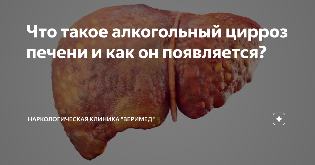 как вылечить алкогольный цирроз печени