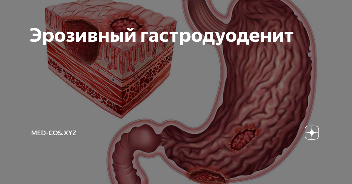 Эрозивный гастродуоденит | Med-cos.xyz | Дзен