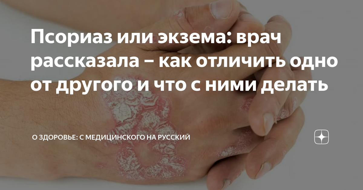 Псориаз или экзема: врач рассказала – как отличить одно от другого и ...