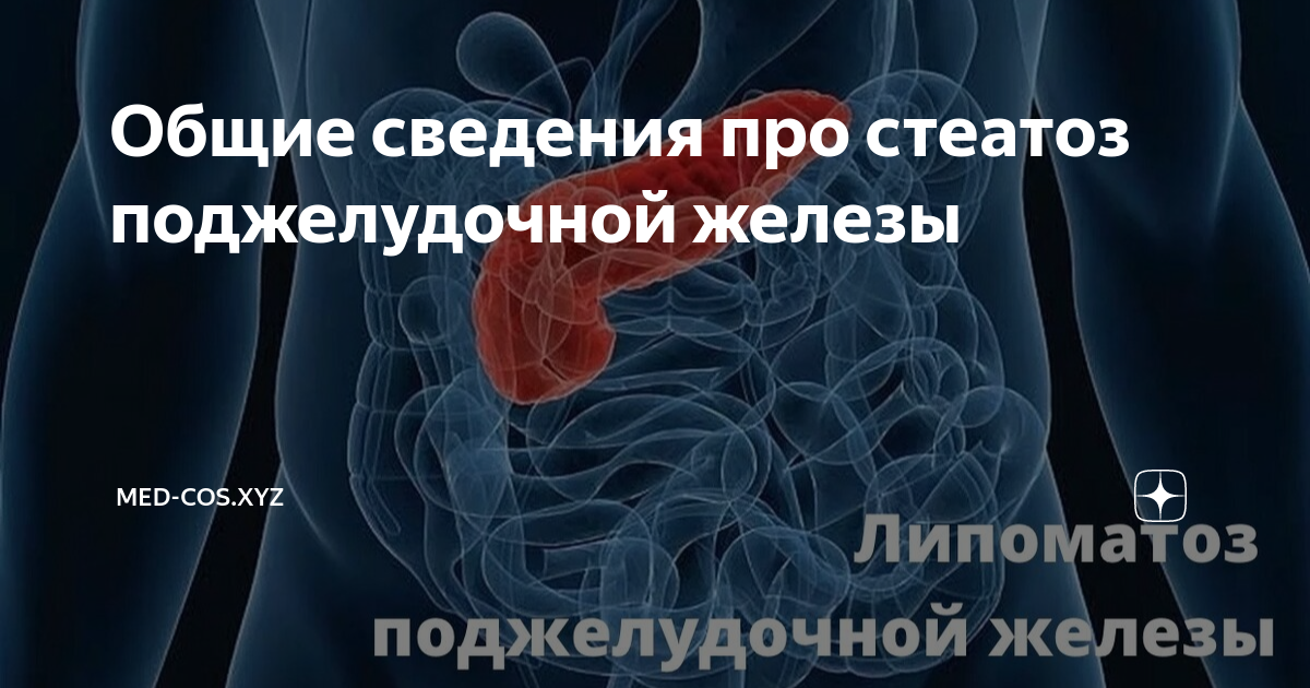 Стеатоз печени что и поджелудочной железы