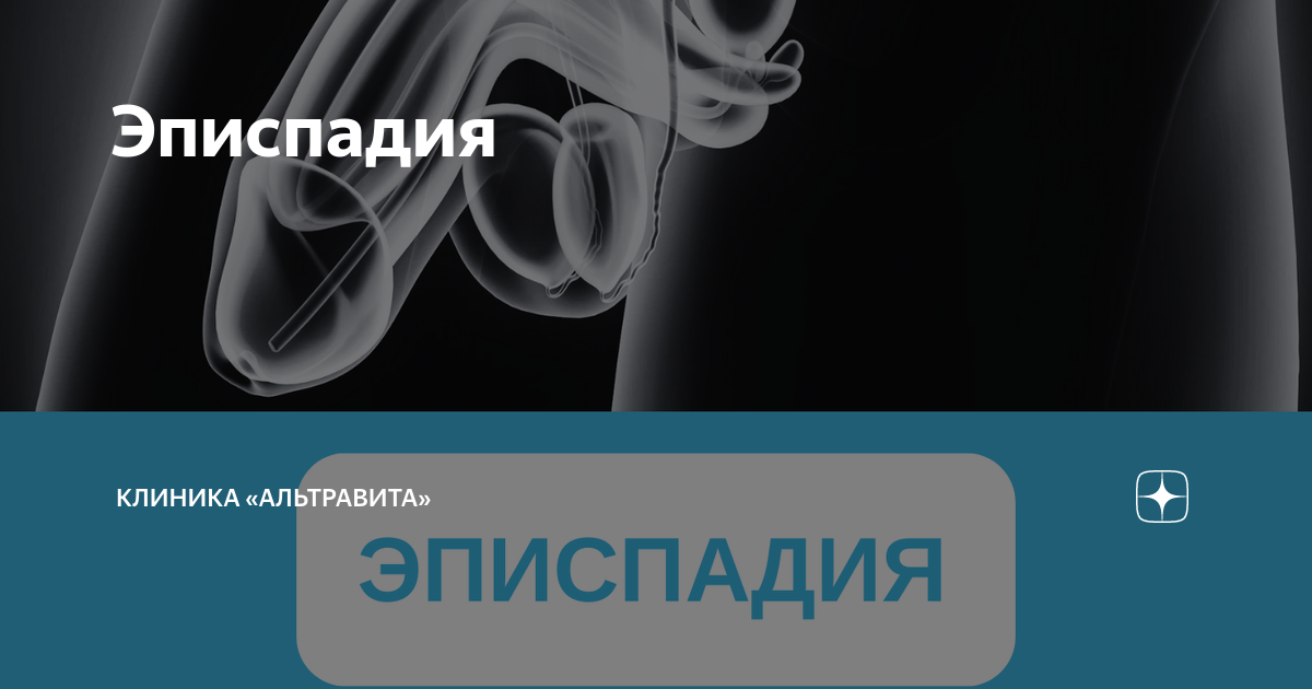 Эписпадия. Эписпадия