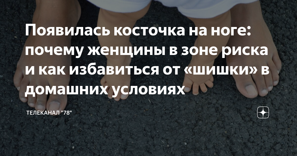 Средство от косточки на большом пальце ноги. Почему появляются косточки на ногах. Красивые женские ступни. Почему появляются косточки на ногах. Подагра большого пальца стопы.