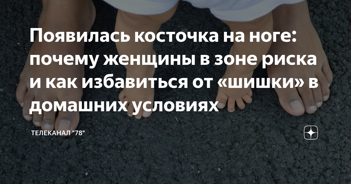 Растет косточка на ноге – что делать? статья Ортоленд