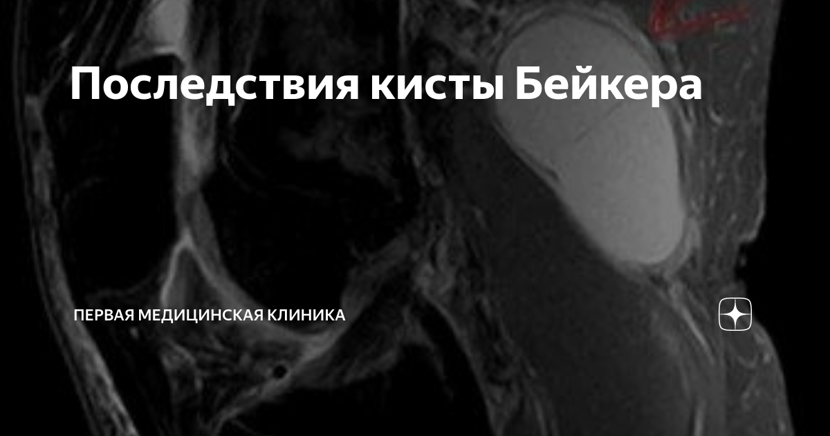 Последствия кисты Бейкера | Первая Медицинская Клиника | Дзен