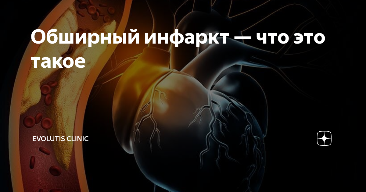Обширный инфаркт — что это такое | Evolutis Clinic | Дзен