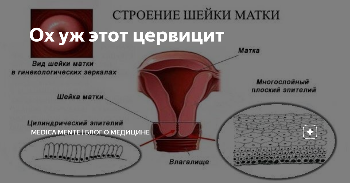 Лечение в гинекологии – воспаление шейки матки и других женских органов