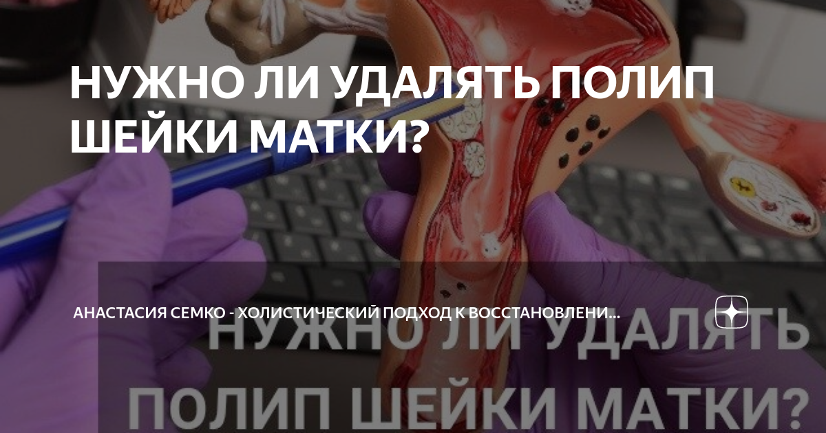 НУЖНО ЛИ УДАЛЯТЬ ПОЛИП ШЕЙКИ МАТКИ? | Анастасия Семко - Холистический ...