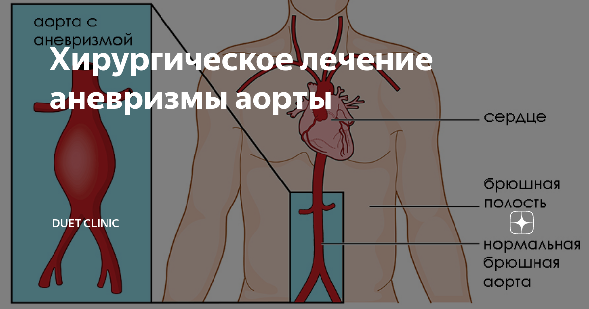Разрыв аневризмы аорты что это