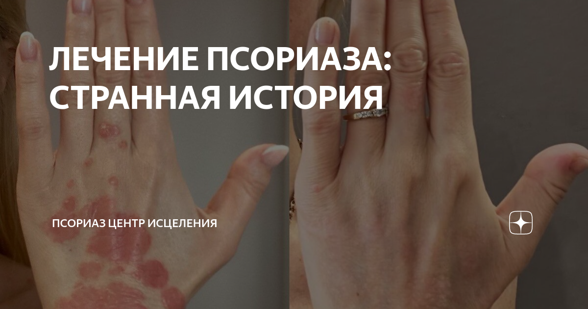 ЛЕЧЕНИЕ ПСОРИАЗА: СТРАННАЯ ИСТОРИЯ | Псориаз Центр Исцеления | Дзен