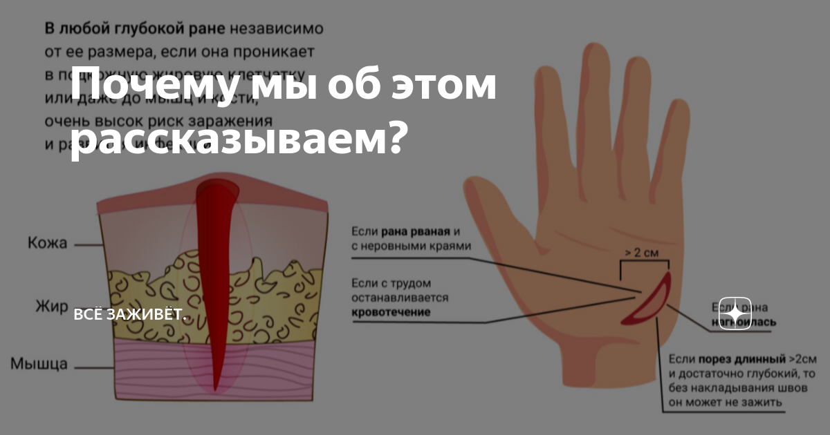 Антибиотики и антисептики для лечения хирургических ран, заживающих вторичным натяжением