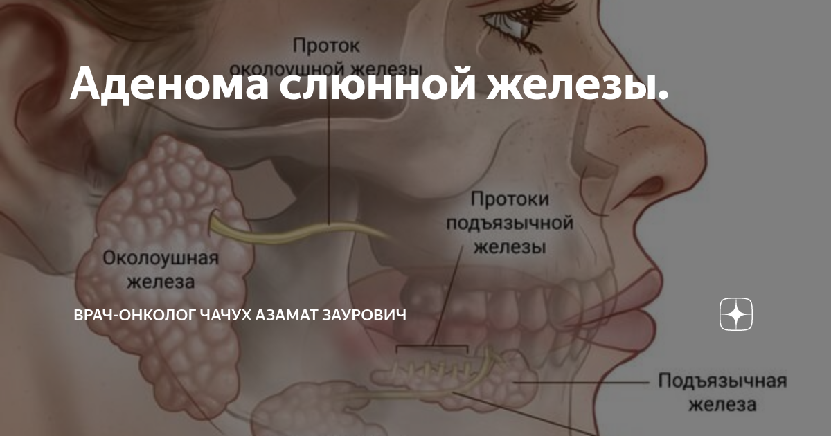 Аденома слюнной железы: лечение