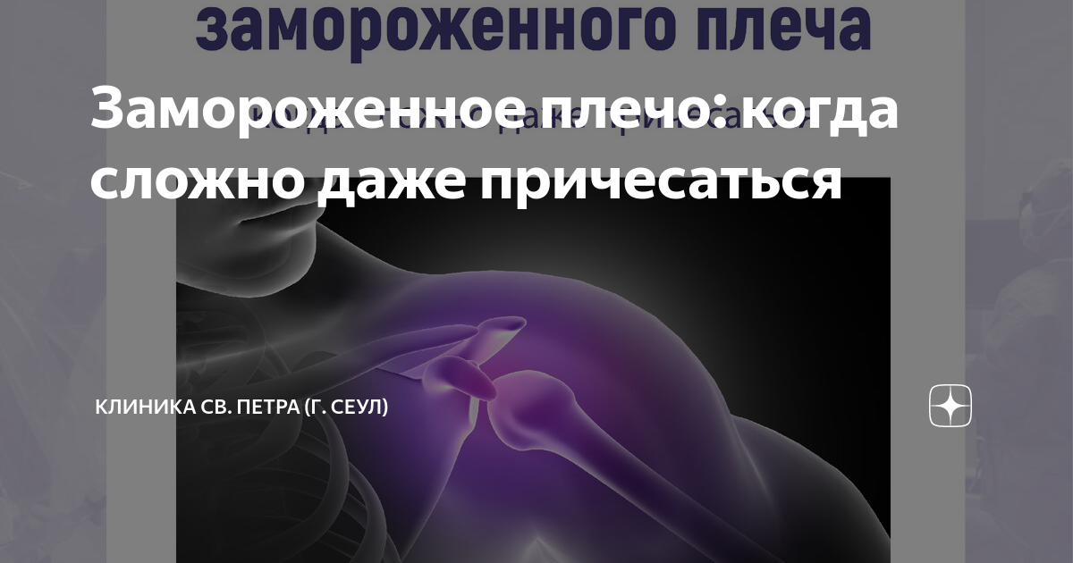 Замороженное плечо: когда сложно даже причесаться | Клиника св. Петра ...