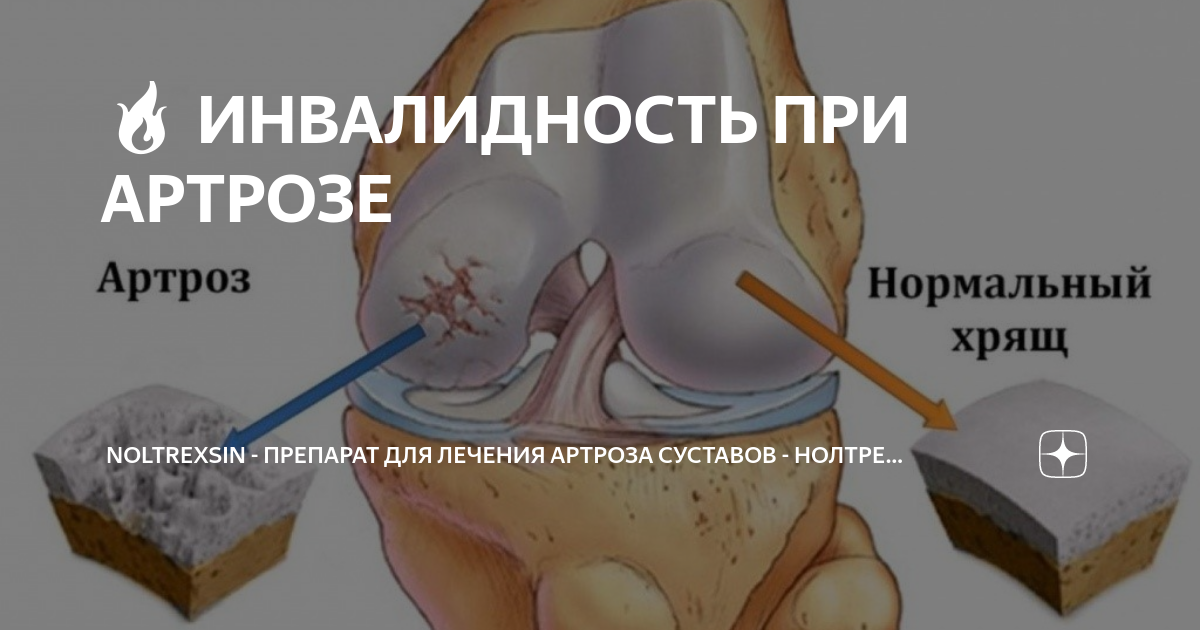 🔥 ИНВАЛИДНОСТЬ ПРИ АРТРОЗЕ | NOLTREXSIN - Препарат для лечения артроза ...