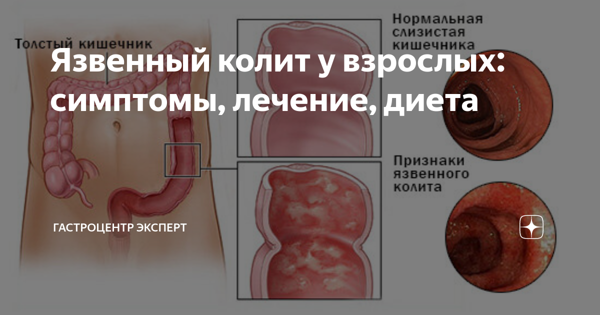 Язвенный колит у взрослых: симптомы, лечение, диета | Гастроцентр ...