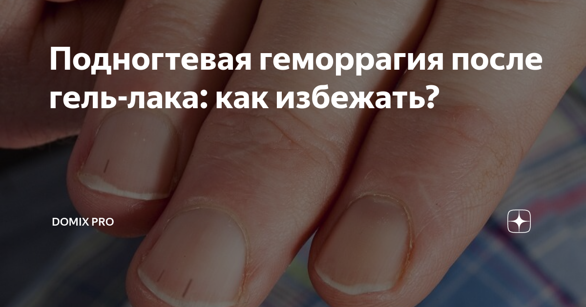 Подногтевая геморрагия после гель-лака: как избежать? | Domix pro | Дзен