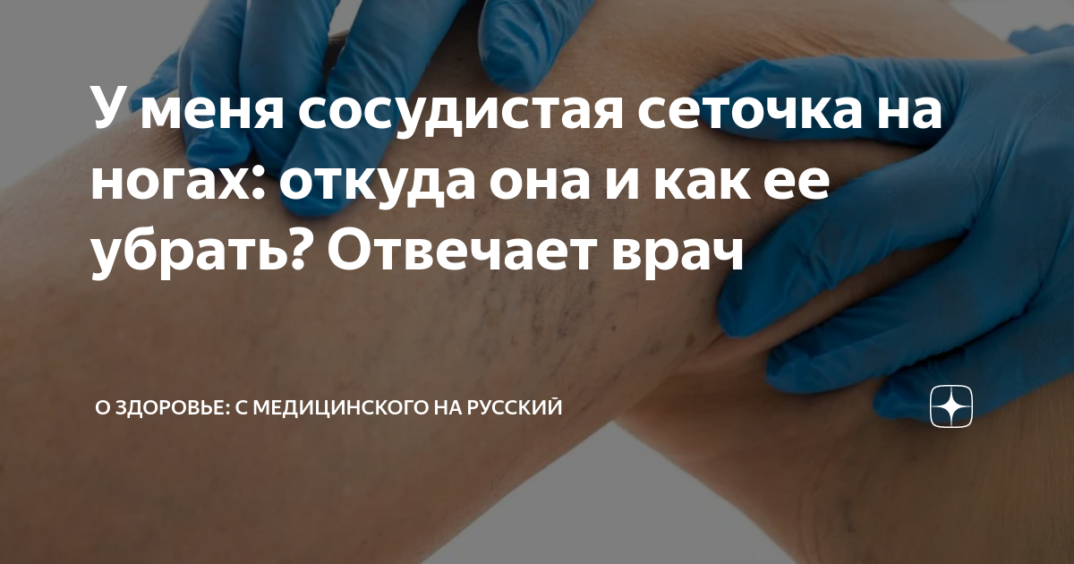 У меня сосудистая сеточка на ногах: откуда она и как ее убрать ...