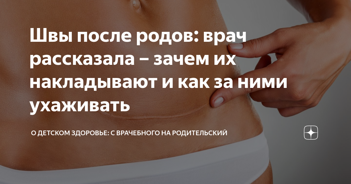 Как выглядит шов после эпизиотомии Разрывы Промежности 65 фото