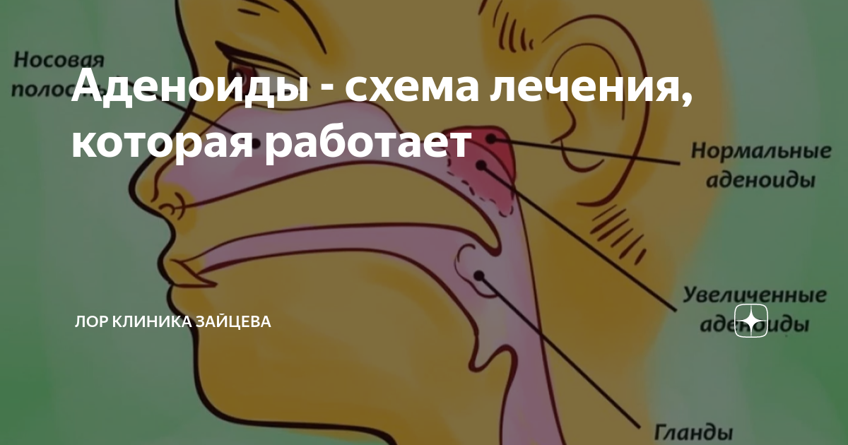 Аденоиды - схема лечения, которая работает | ЛОР КЛИНИКА ЗАЙЦЕВА | Дзен