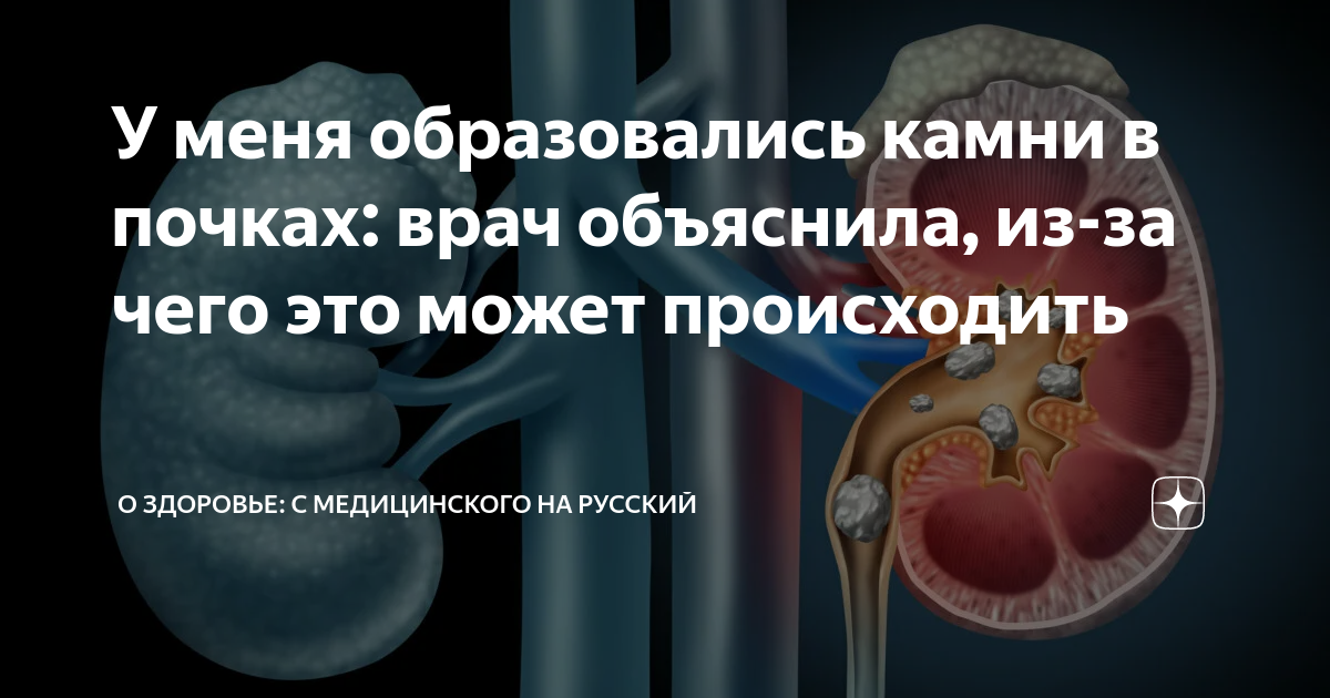 У меня образовались камни в почках: врач объяснила, из-за чего это ...