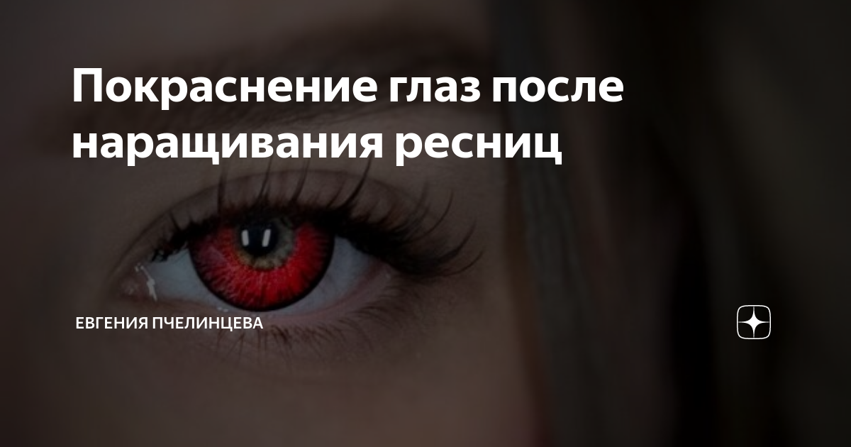 Как снять покраснение глаз после наращивания ресниц