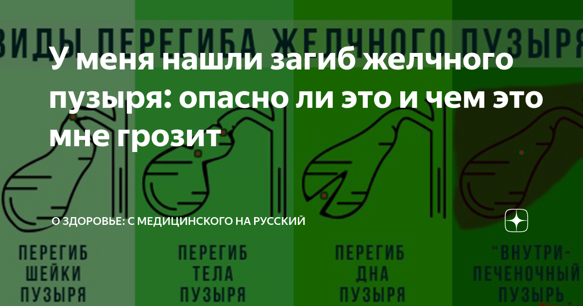 Перегиб желчного пузыря питание. Перегиб желчного пузыря. Загиб желчного пузыря. Загиб желчного пузыря симптомы. Загиб желчного пузыря опасно ли.